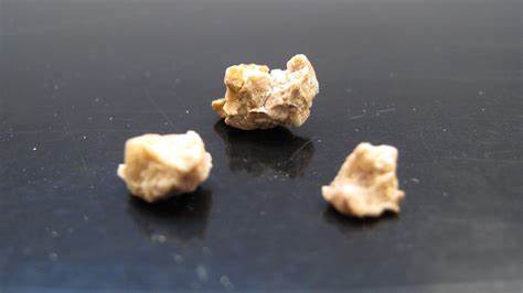 Как выглядят уратные камни Как выглядят уратные камни