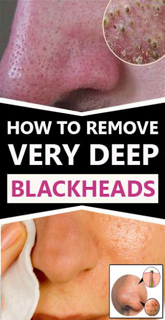 10 Ways To Get Rid Of Deep Blackheads Healthy Care 1001