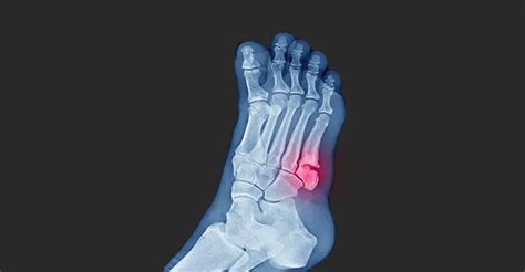 Jones Fracture Causes Symptoms Treatments And Recovery