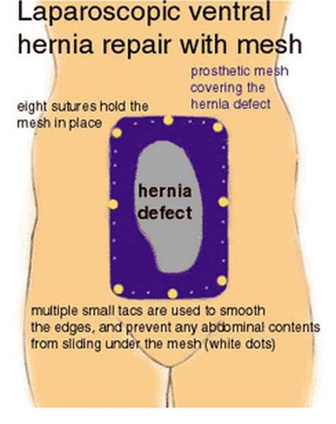 The 25 Best Umbilical Hernia Ideas On Pinterest Hernia Exercises