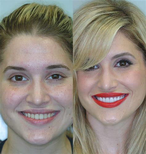 Porcelain Veneers Cosmetic Dentists Of Houston Cosmetic Dentist General Dentistry