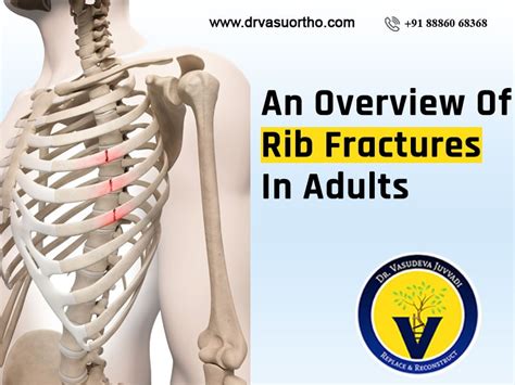 Rib Fracture Treatment In Adults An Overview Vasudeva