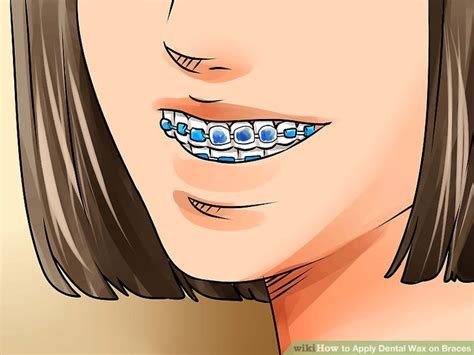 Why use dental wax for braces? How to Apply Dental Wax on Braces: 12 Steps (with Pictures)