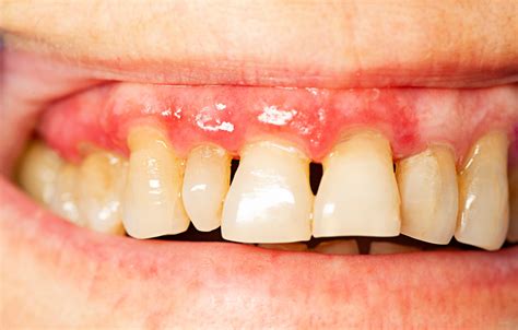 Some bacteria in plaque are harmless. Classification of Periodontal Diseases - Revise Dental