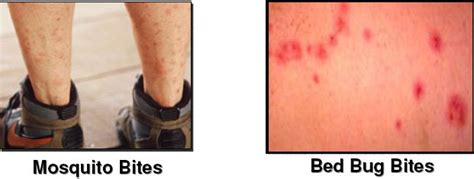 Bed Bug Bite Marks Body Pictures Treatment Free Brochure