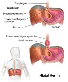 A hiatal hernia happens when part of the stomach or other abdominal tissue slides up into the middle of the chest through the hiatus. Hiatal Hernia Causes, Symptoms, Diagnosis and Treatment - Natural Health News