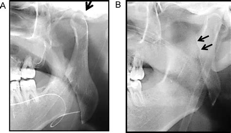 Complications After Intraoral Vertical Ramus Osteotomy Relationship To