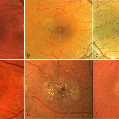 Fundus Fluorescein Angiography Ffa Features Of Macular Telangiectasia
