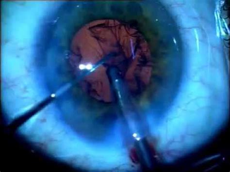 Aravind Eye Hospital Cataract Surgery Madurai India Youtube