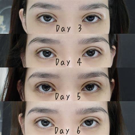 In surgery, an incision is made along the whole upper eyelid, fat pads are removed partially, and certain layers of the skin is anchored to deeper structures to create a lid crease. L I A N M E I T I N G : My double eyelid surgery experience