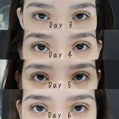 How is double eyelid surgery done? L I A N M E I T I N G : My double eyelid surgery experience