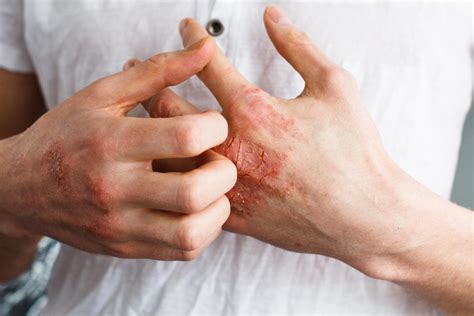 Dermatite Orticaria Da Stress Immagini Sintomi E Cibi Da Evitare 2023