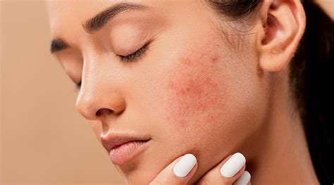 These Ingredients Will Help Soothe Your Skins Redness In No Time Says