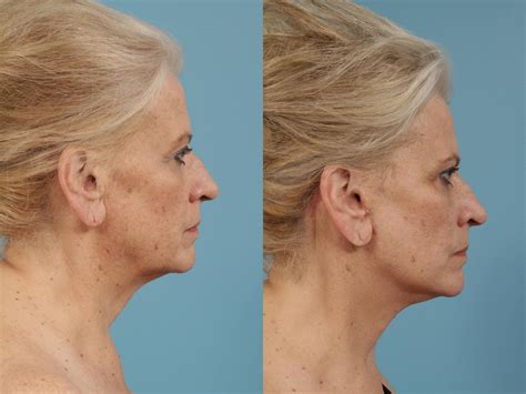 Neck Lift Before And After Photos Patient 154 Chicago Il Tlkm