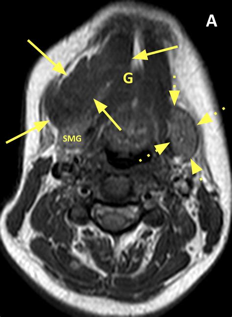 Ranula Diagnosis Mri Online