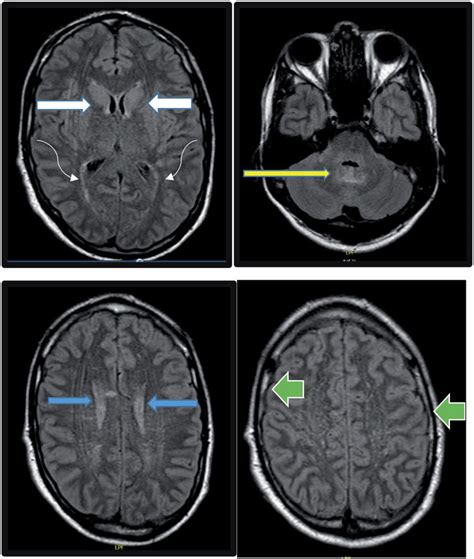 Brain Mri With And Without Contrast Showing Bilaterally Symmetric