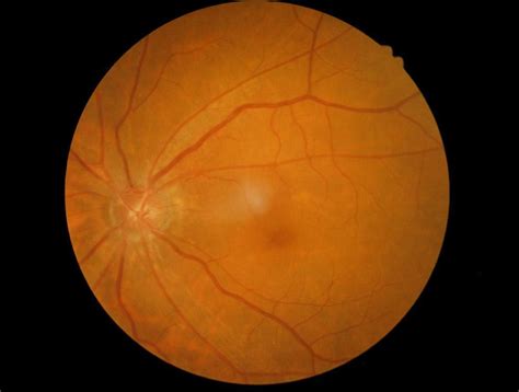 What are the early signs of macular degeneration. Early Signs of Macular Degeneration