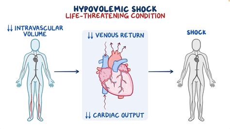 The Form Of Circulatory Shock Known As Hypovolemic Sh