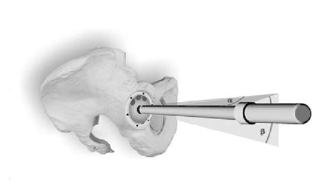 Operative Inclination And Anteversion Of The Acetabular Cup