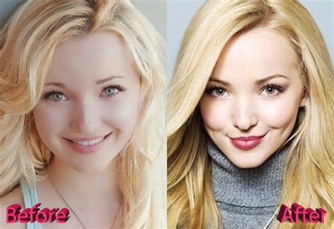 Dove Cameron Plastic Surgery Before And After Plastic Surgery Dove