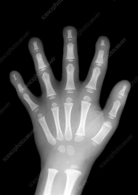 Childs Hand X Ray Stock Image P1160841 Science Photo Library
