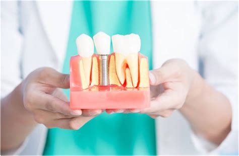 An Overview Of Bone Grafting Procedure For Dental Implants