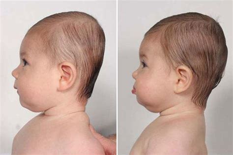More Parents Ignore Sids Guidelines To Prevent Flat Head Syndrome