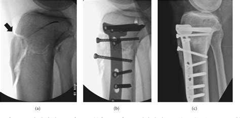 Distal Tibial Osteotomy