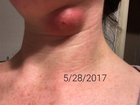 How I Healed My Sebaceous Cyst The Centsable Shoppin