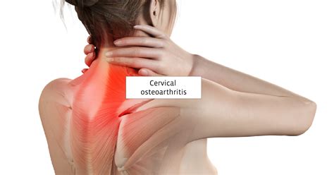 What Causes Neck Pain Understanding Cervical Spondylosis And Its