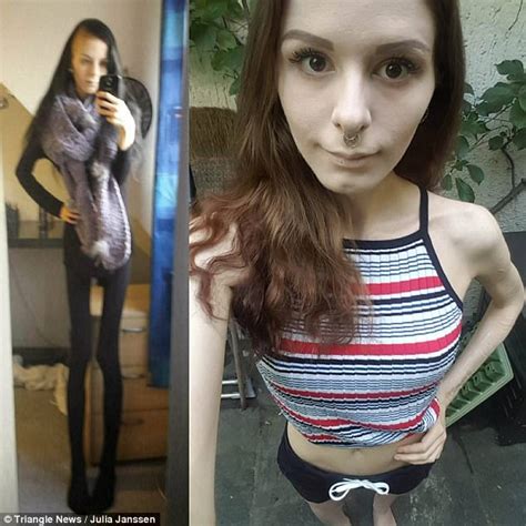 Recovering Anorexic From Zurich Hid Food In Her Ears Daily Mail Online