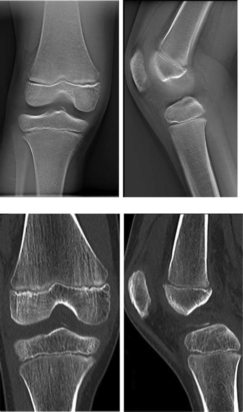 Computerized Tomography Clearly Showed A Tibial Eminence Fracture And