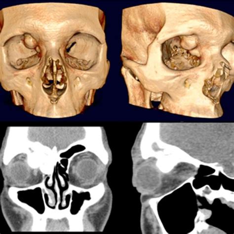 3d Ct Images Showing The Right Fronto Ethmoidal Osteoma With Orbital