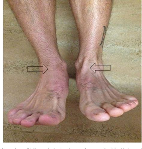 Tibialis Anterior Tendon Rupture As A Complication Of First