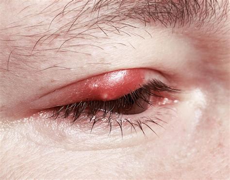 What Are The Different Eye Infection Symptoms With Pictures