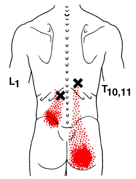 Quadratus Lumborum The Trigger Point And Referred Pain Guide