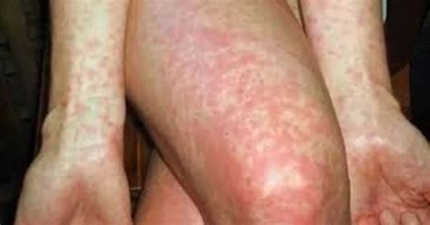 What Is Scarlet Fever How To Spot The Symptoms As Infections Reach