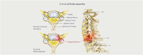 Cervical Radiculopathy Motus Physical Therapy