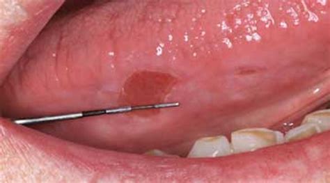 Breakthrough Clinical Oral Pathology Case No 17 Dentistryiq