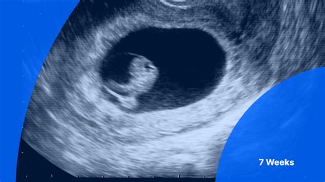 7 Weeks Pregnant Ultrasound Pockethealth