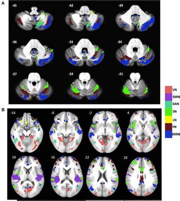 Frontiers Structural Atrophy And Functional Dysconnectivity Patterns