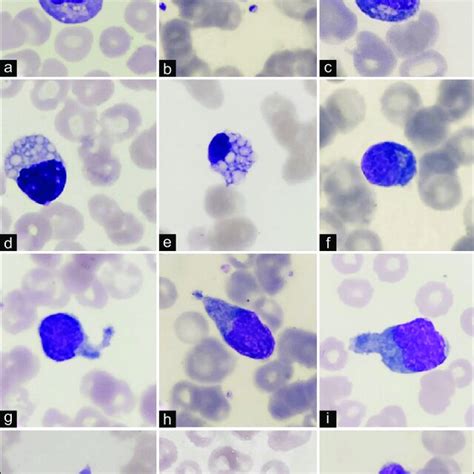 A F Atypical Lymphoid Cells Of Class A With Immunoglobulin Crystals