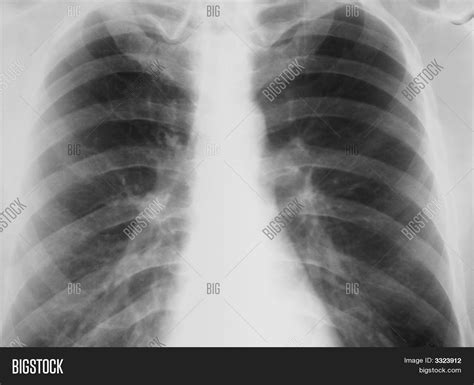 Real World Chest X Ray With Symptom Of Chronic Bronchitis