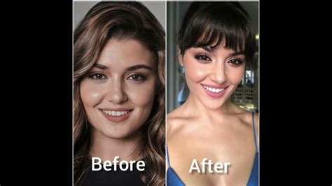 Turkish Actress Hande Ercel Before And After Plastic Surgery 😯 Youtube
