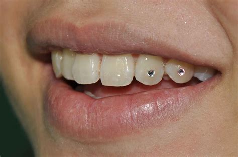 Images For Diamond Tooth Implant Dental Jewelry Diamond Teeth