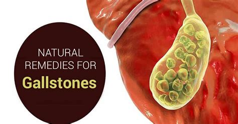 Home Remedies For Gallstones Gotta Do The Right Thing
