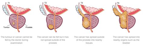 If prostate cancer is found after a biopsy, tests may be conducted to determine if the cancer cells have spread beyond the prostate to other. Sunshine Coast Urology » What is prostate cancer?
