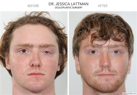 Ptosis Repair Before And After Gallery New York Nyc And Manhattan