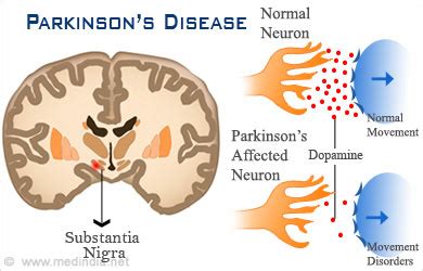 These nerve cells die or become impaired, losing the ability to produce an important chemical called dopamine. Advancements in a Cure for Parkinson's Disease | The ...