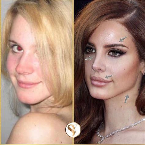 Lana Del Rey Botox Before And After